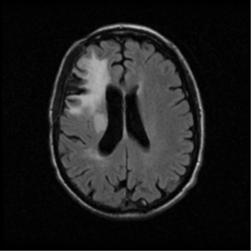 File:Anaplastic meningioma with recurrence (Radiopaedia 34452-35789 Axial FLAIR 15).png