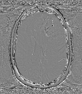 Anaplastic oligodendroglioma (Radiopaedia 83500-98599 Axial SWI - phase 52).png