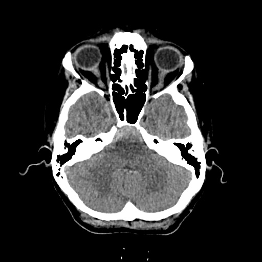 Aneursym related subarachnoid hemorrhage with hydrocephalus (Radiopaedia 45105-49083 Axial non-contrast 9).jpg