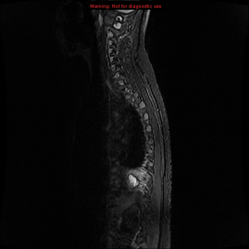 File:Aneurysmal bone cyst (Radiopaedia 9419-10103 Sagittal T2 10).jpg
