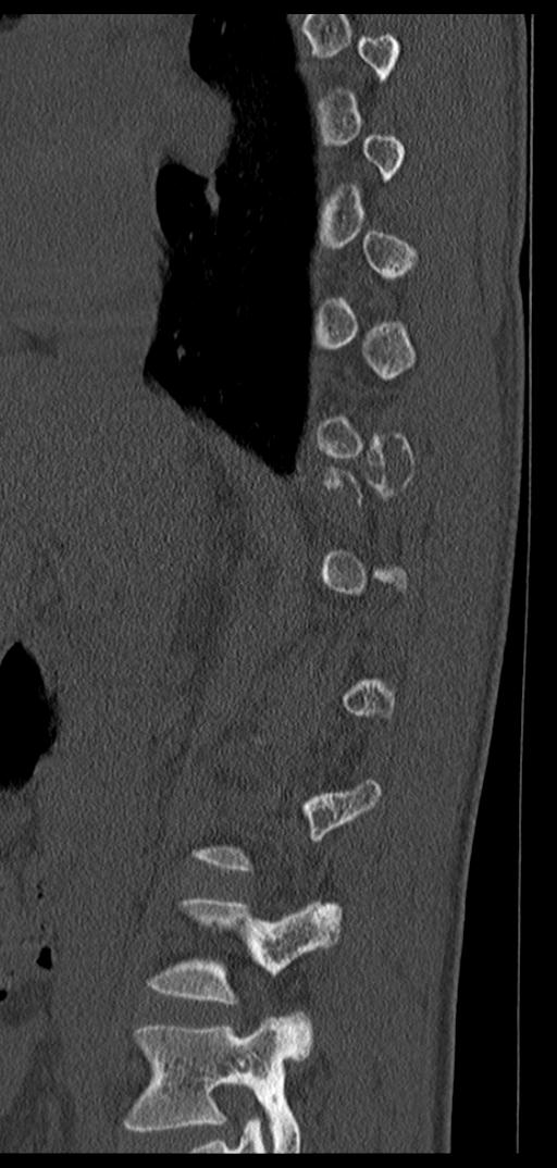 Aneurysmal bone cyst T11 (Radiopaedia 29294-29721 Sagittal bone window 54).jpg