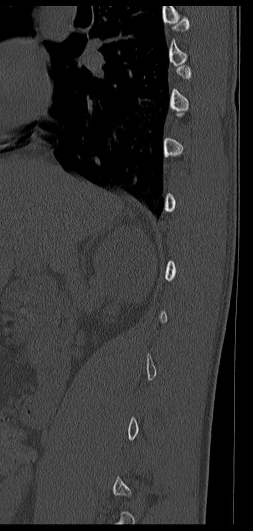 Aneurysmal bone cyst T11 (Radiopaedia 29294-29721 Sagittal bone window 62).jpg