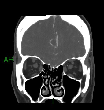 Aneurysmal subarachnoid hemorrhage with intra-axial extension (Radiopaedia 84371-99732 C 78).jpg