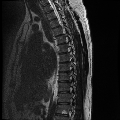 File:Angiolipoma - thoracic spine (Radiopaedia 28242-28479 Sagittal T2 5).jpg