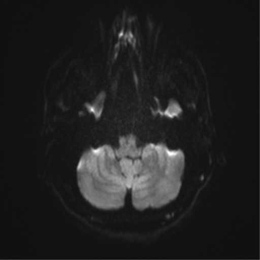 Angular epidermoid cyst (Radiopaedia 46908-51438 Axial DWI 72).png