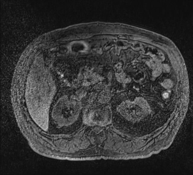 Annular pancreas (Radiopaedia 38292-40320 Axial T1 fat sat 37).png
