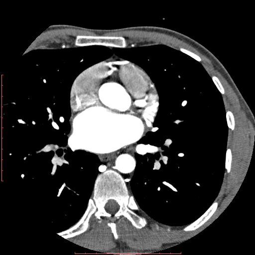Anomalous left coronary artery from the pulmonary artery (ALCAPA) (Radiopaedia 70148-80181 A 111).jpg