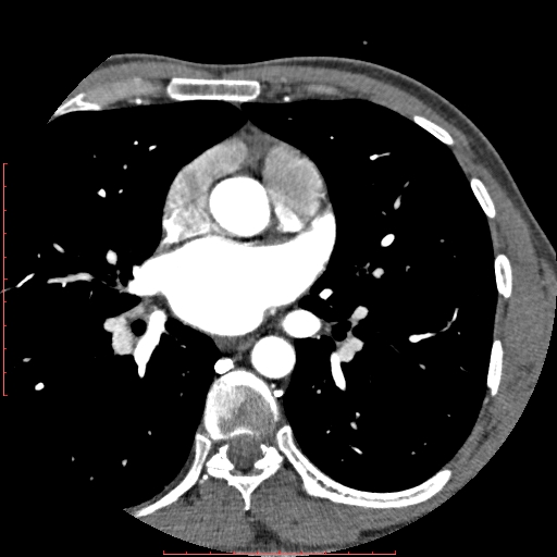 Anomalous left coronary artery from the pulmonary artery (ALCAPA) (Radiopaedia 70148-80181 A 89).jpg