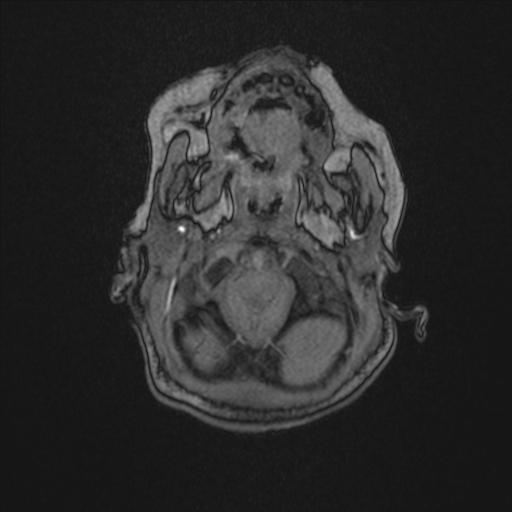 Anoxic brain injury (Radiopaedia 79165-92139 Axial MRA 20).jpg