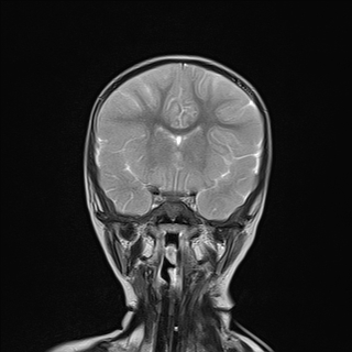 File:Anoxic brain injury (Radiopaedia 79165-92139 Coronal T2 11).jpg