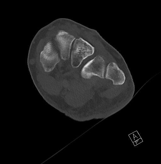 Anterior calcaneal process fracture (Radiopaedia 63353-71943 Axial bone window 81).jpg