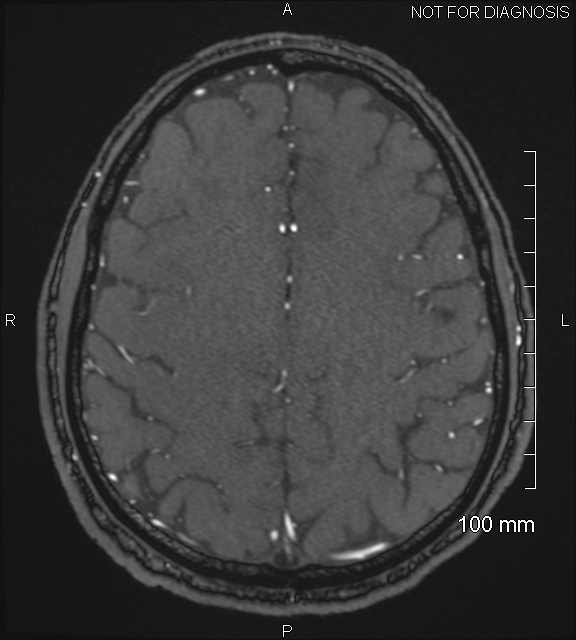 Anterior cerebral artery aneurysm (Radiopaedia 80683-94127 Axial MRA 185).jpg