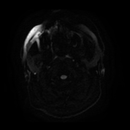 Anterior cerebral artery infarction (Radiopaedia 46794-51323 Axial DWI 2).jpg