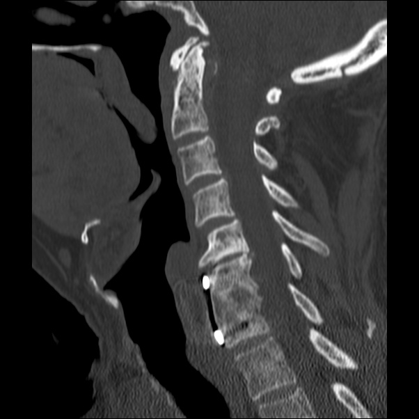 Anterior cervical postdiscectomy arthrodesis (Radiopaedia 32678-33646 Sagittal bone window 35).jpg