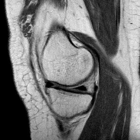 File:Anterior cruciate ligament mucoid degeneration (Radiopaedia 60853-68633 Sagittal PD 12).jpg