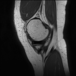 Anterior cruciate ligament rupture and posteromedial corner injury (Radiopaedia 67338-76723 Sagittal PD 34).jpg