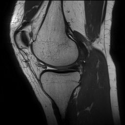 Anterior cruciate ligament rupture and posteromedial corner injury (Radiopaedia 67338-76723 Sagittal PD 63).jpg