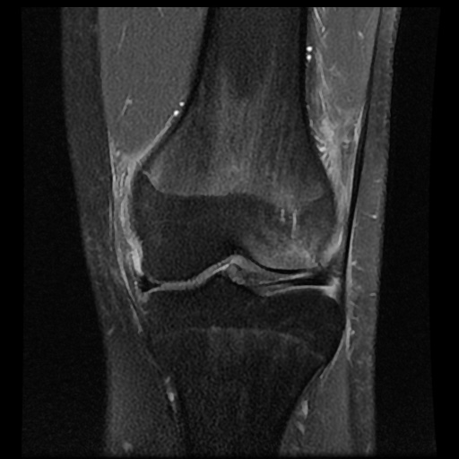 File:Anterior cruciate ligament tear (Radiopaedia 61500-69462 Coronal PD fat sat 10).jpg