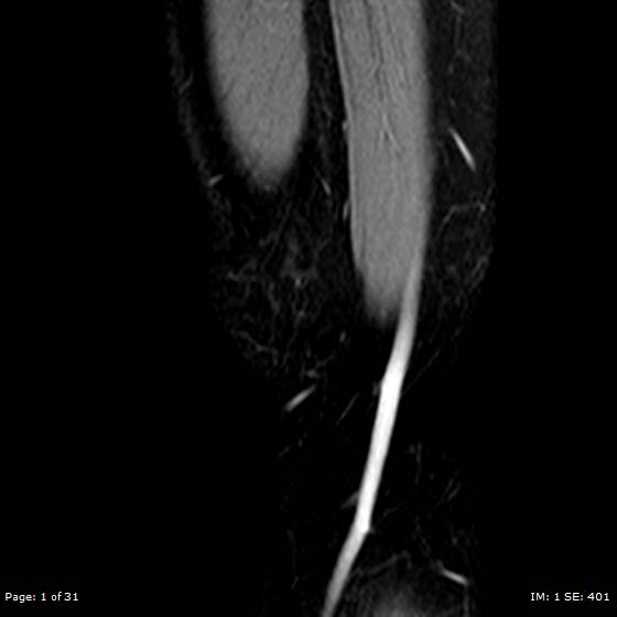 File:Anterior cruciate ligament tear (Radiopaedia 70783-80964 Sagittal STIR 1).jpg