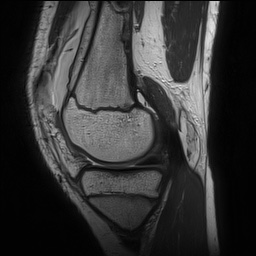 File:Anterior cruciate ligament tear - pediatric (Radiopaedia 62152-70260 Sagittal PD 62).jpg