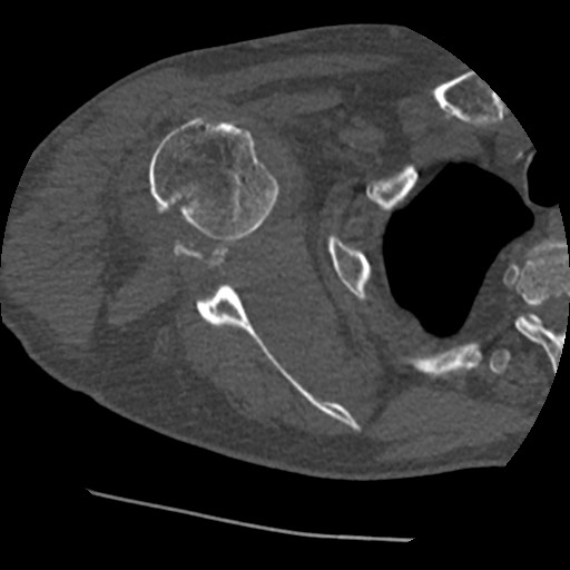 File:Anterior glenohumeral dislocation with Hill-Sachs lesion (Radiopaedia 62877-71249 Axial bone window 45).jpg