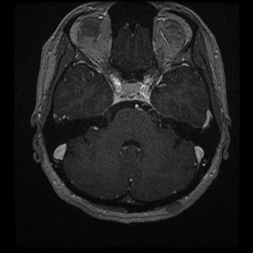 Anterior inferior cerebellar artery vascular loop - type II (Radiopaedia 70991-81209 Axial T1 C+ 30).jpg