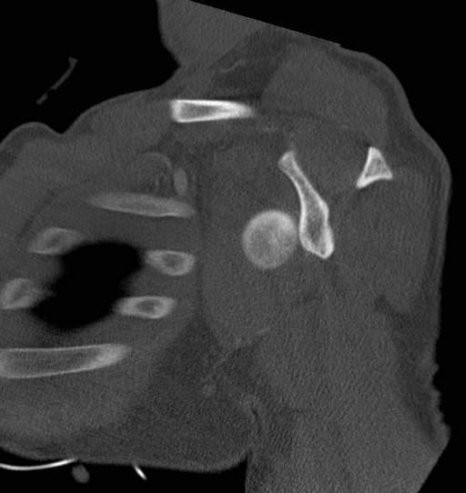 Anterior shoulder dislocation with Hill-Sachs and bony Bankart lesions (Radiopaedia 40424-42974 Sagittal bone window 30).png
