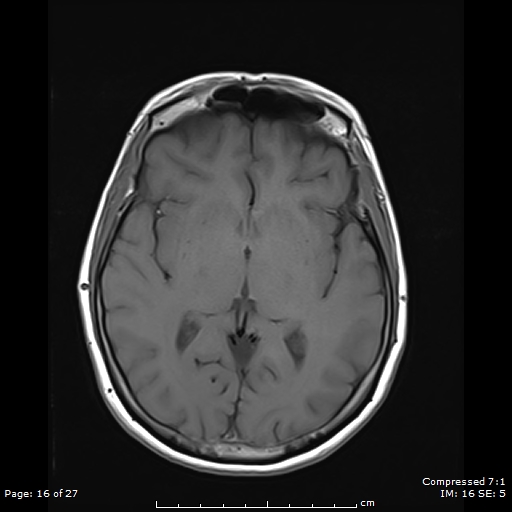 File:Anterior temporal lobe perivascular space (Radiopaedia 88283-104914 Axial T1 16).jpg