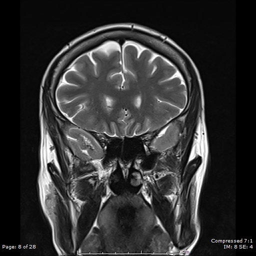 File:Anterior temporal lobe perivascular space (Radiopaedia 88283-104914 Coronal T2 8).jpg