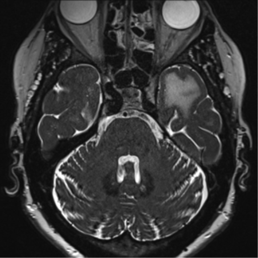 File:Anterior temporal pole cysts (Radiopaedia 46629-51102 Axial 19).png