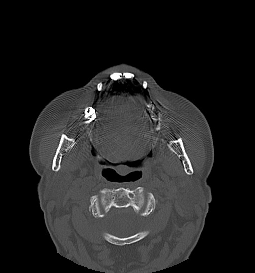Anterior temporomandibular joint dislocation (Radiopaedia 59430-66784 Axial non-contrast 33).jpg