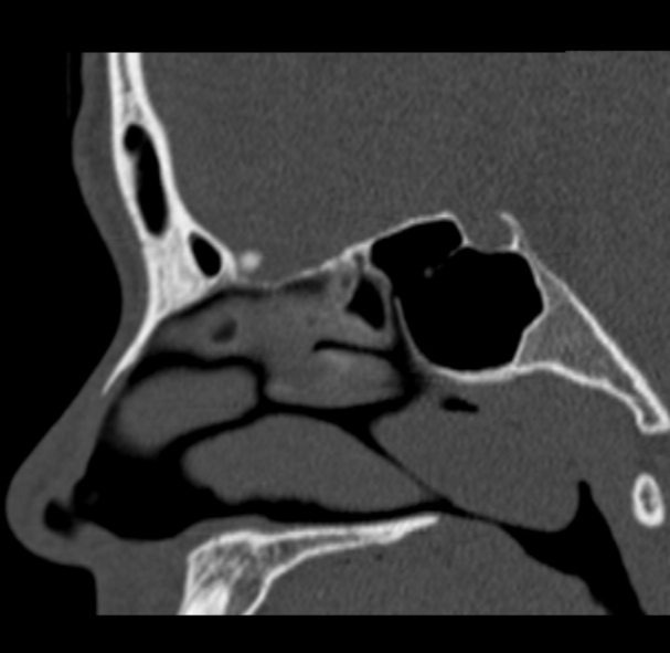 Antrochoanal polyp (Radiopaedia 33984-35202 Sagittal bone window 38).jpg