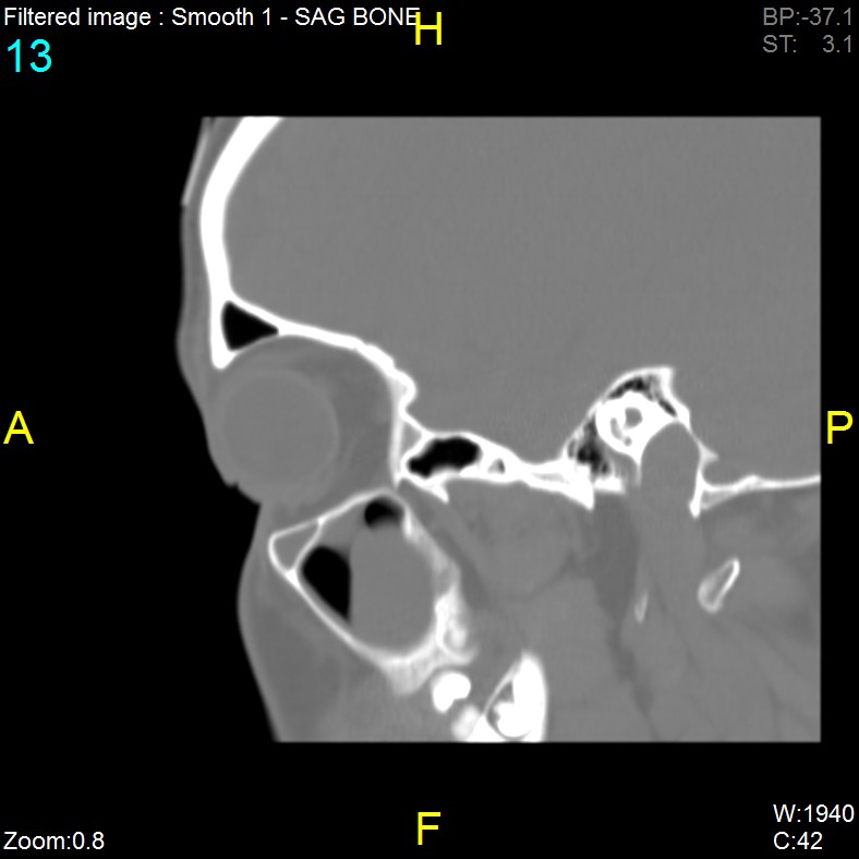 Antrochoanal polyp (Radiopaedia 65101-74094 Sagittal bone window 13).jpg