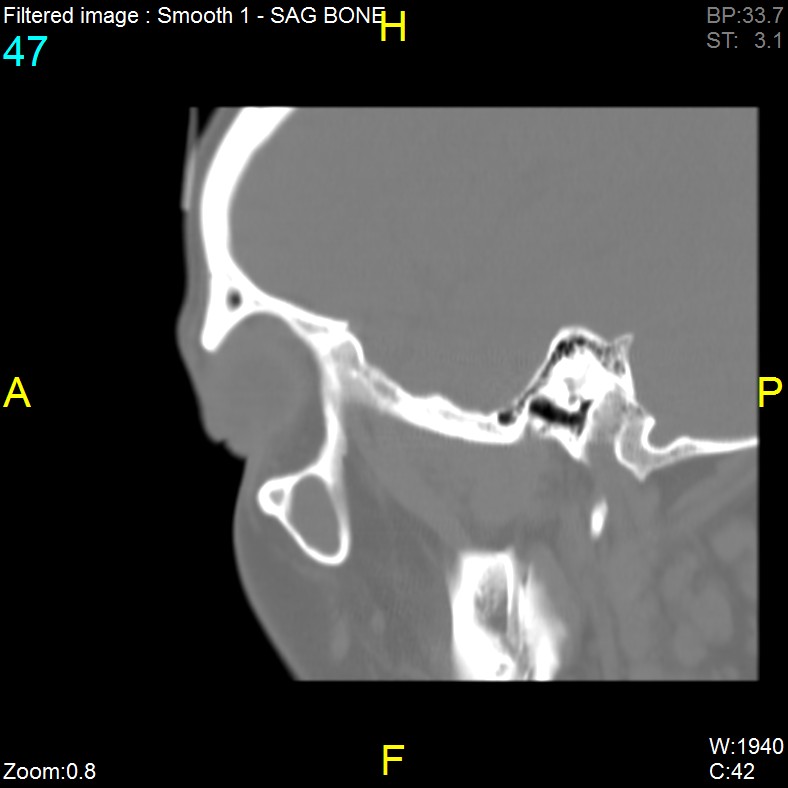 Antrochoanal polyp (Radiopaedia 65101-74094 Sagittal bone window 47).jpg