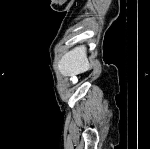 File:Aortic aneurysm and Lemmel syndrome (Radiopaedia 86499-102554 D 3).jpg