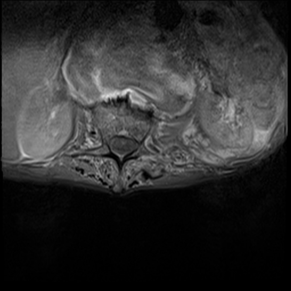 File:Aortic aneurysm with spinal destruction (Radiopaedia 42301-45409 Axial T1 fat sat 7).jpg