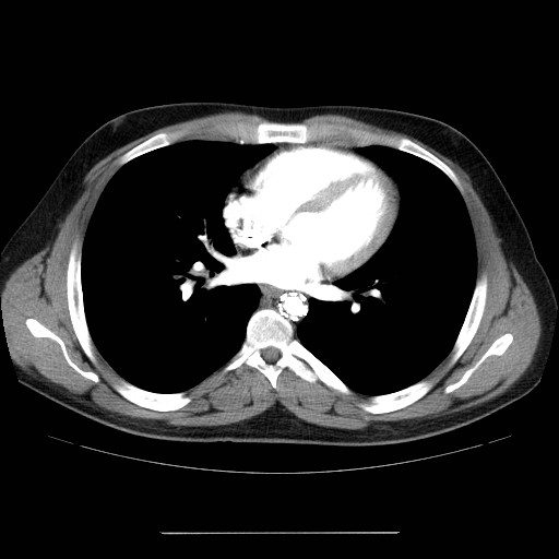 File:Aortic arch stent (Radiopaedia 30030-30595 D 22).jpg