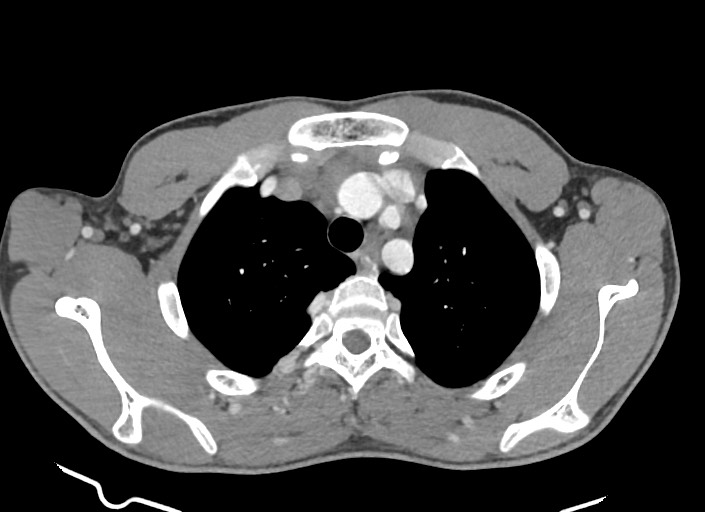 File:Aortic coarctation with aneurysm (Radiopaedia 74818-85828 A 160).jpg