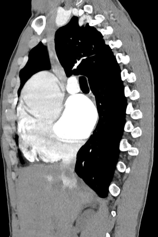 Aortic coarctation with aneurysm (Radiopaedia 74818-85828 B 67).jpg