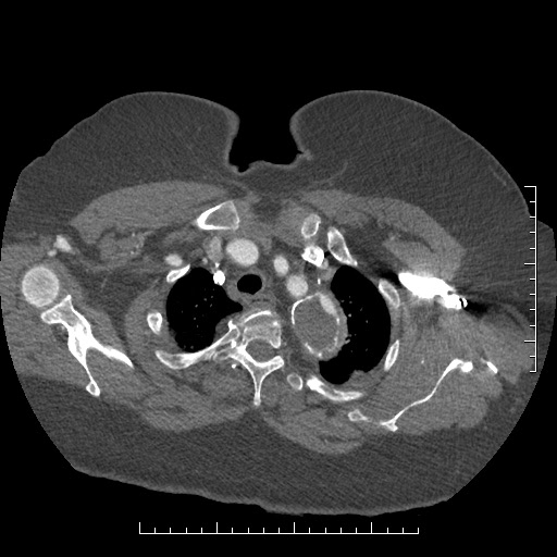 Aortic dissection- Stanford A (Radiopaedia 35729-37268 A 6).jpg