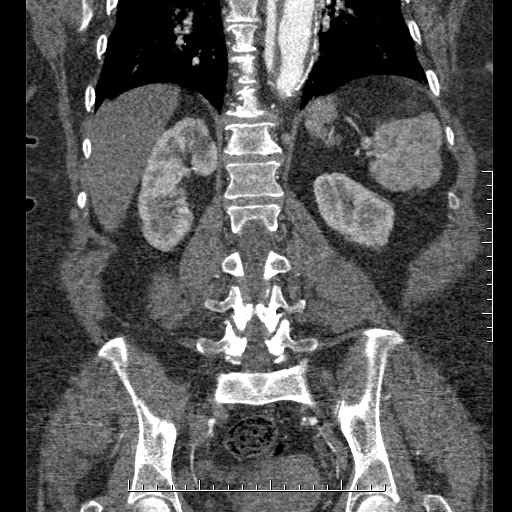 Aortic dissection- Stanford A (Radiopaedia 35729-37268 F 10).jpg
