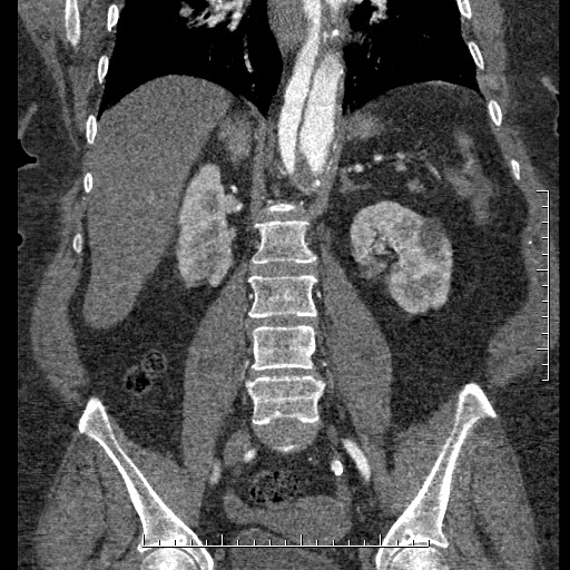 File:Aortic dissection- Stanford A (Radiopaedia 35729-37268 F 19).jpg
