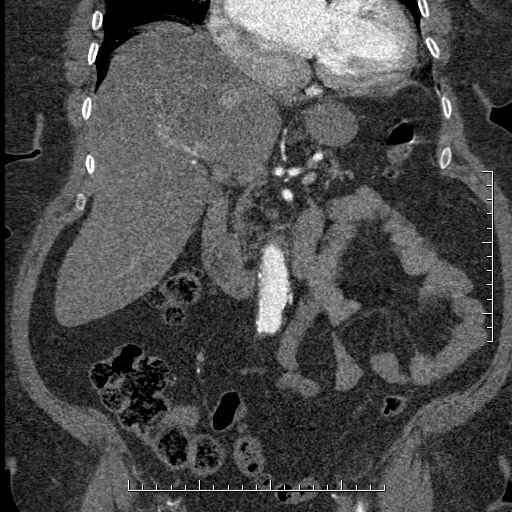 Aortic dissection- Stanford A (Radiopaedia 35729-37268 F 42).jpg