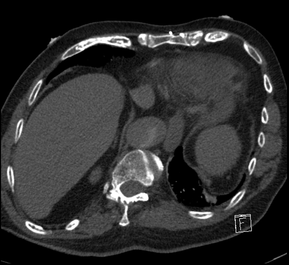 Aortic dissection (CTPA) (Radiopaedia 75506-86751 Axial C+ CTPA 113).jpg