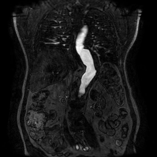 Aortic dissection - Stanford A - DeBakey I (Radiopaedia 23469-23551 D 156).jpg