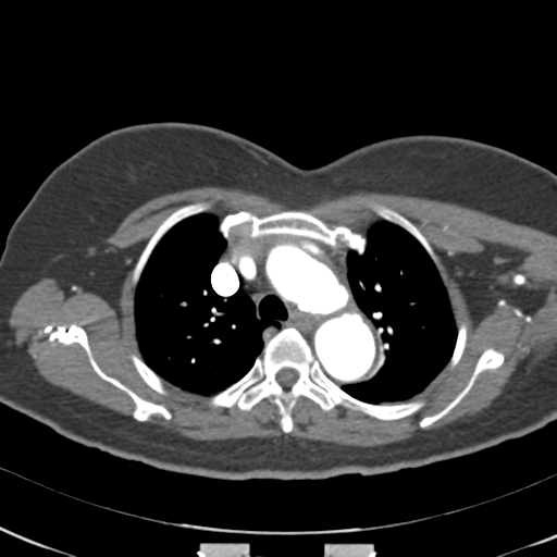 File:Aortic dissection - Stanford type A (Radiopaedia 39073-41259 A 21).png