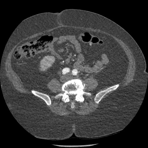 File:Aortic dissection - Stanford type B (Radiopaedia 88281-104910 A 132).jpg