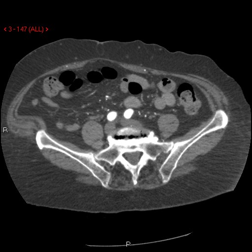 Aortic intramural hematoma (Radiopaedia 27746-28001 A 147).jpg