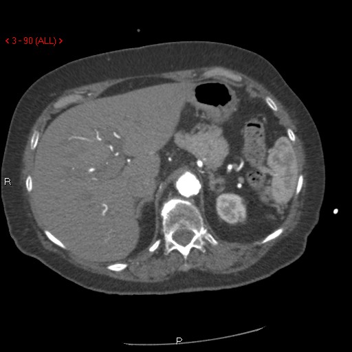 File:Aortic intramural hematoma (Radiopaedia 27746-28001 A 90).jpg