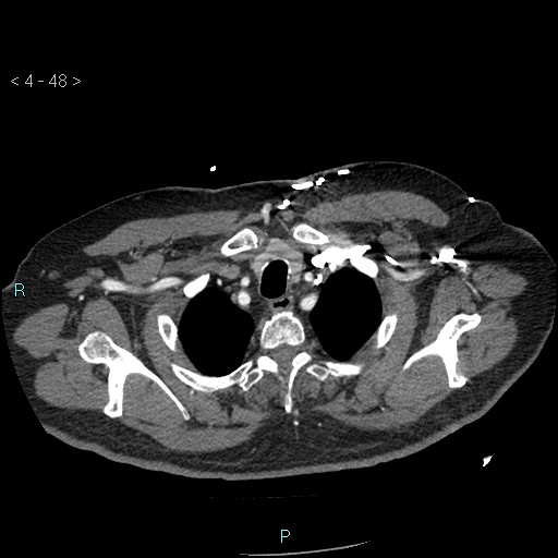 File:Aortic intramural hematoma (Radiopaedia 48463-53380 B 22).jpg